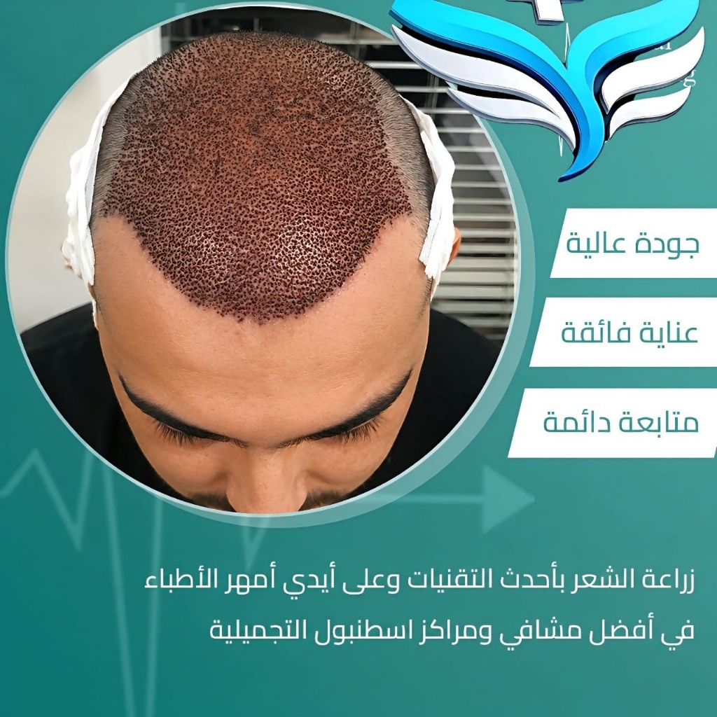 نتائج زراعة الشعر الفائقة والناجحة في إسطنبول